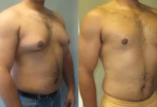 Gynecomastia in Dubai