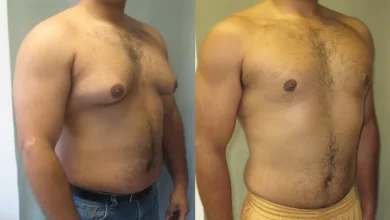 Gynecomastia in Dubai
